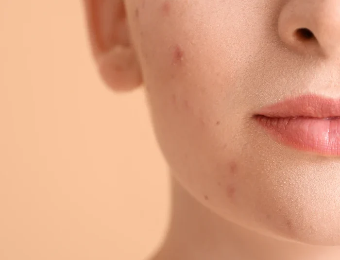 Terapia Fotodynamiczna (PDT)